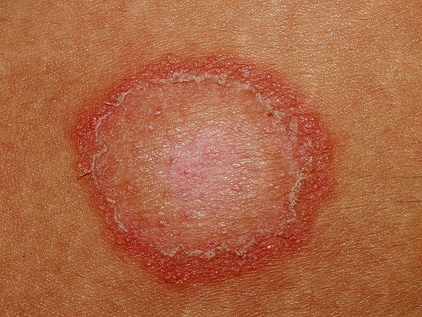 Ringworm of the Skin Home Remedies and Treatments