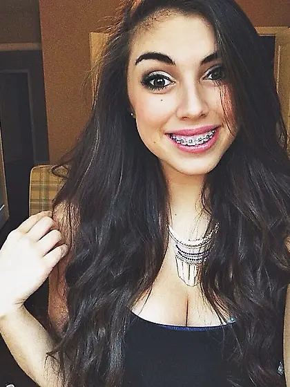 braces