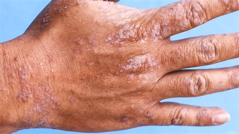 What to Do If Hand Eczema Is Impacting Your Work | Gladskin