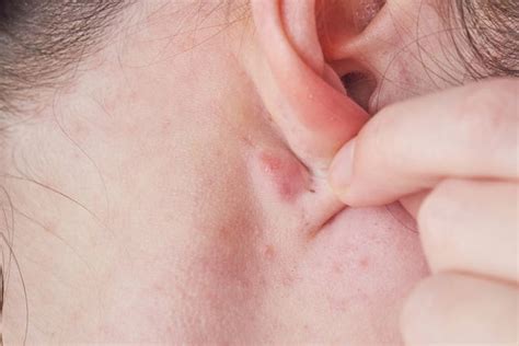 Swollen Lymph Nodes Behind Ear Serious - Infoupdate.org