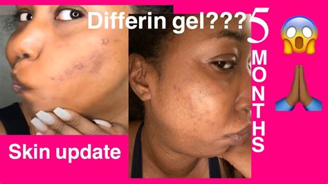 Differin Gel REVIEW: 5 month update is it worth the purge phase?? - YouTube