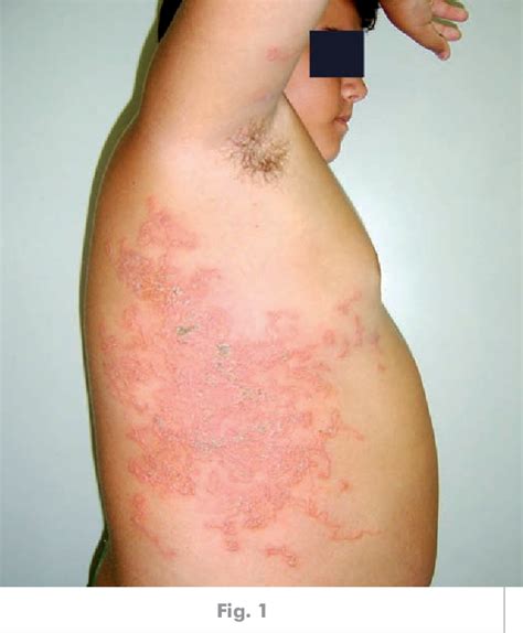 Figure 1 from Cutaneous Larva Migrans | Semantic Scholar