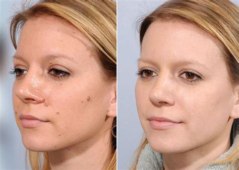 Before & After - Mole Removal