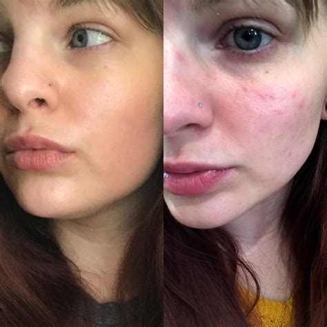 [B&A] Think I am finally past the differin purge and feel great with no makeup! : r ...