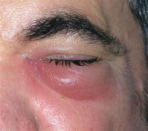 Cellulitis eye, causes, signs, symptoms, diagnosis, treatment & prognosis