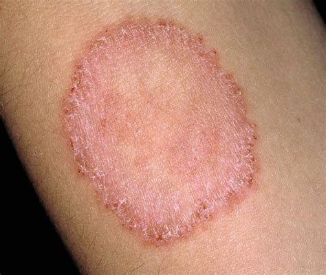 What is Ringworm and How to Identify It? - Speedy Sticks | Mobile Lab Services