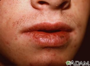 Melanoma Lip Symptoms - Doctor Heck