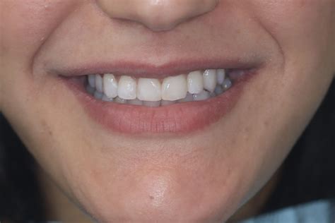 Restoration Before & After – The Gentle Dentist