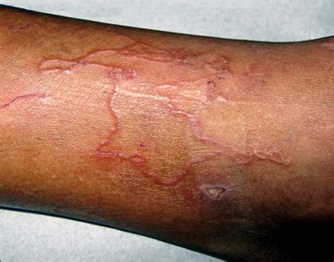 How to Treat Cutaneous Larva Migrans Naturally in Ayurveda