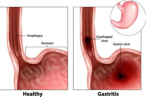 Gastritis - Causes, Symptoms & Signs | Gleneagles Hospital