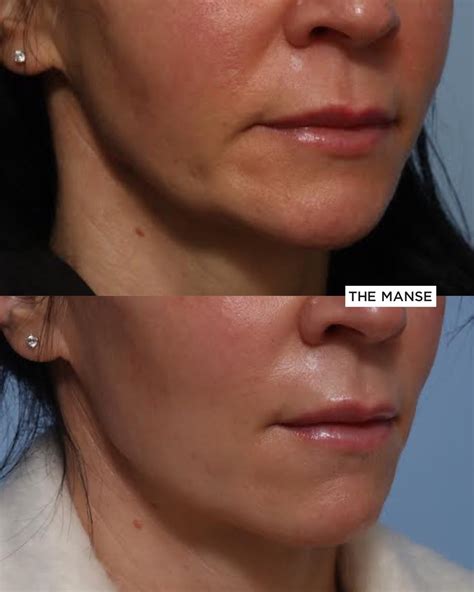 Dermal Filler for Jowls and Marionette Folds - Best Cosmetic Clinic Sydney. Advanced practitioners