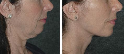 SMAS Face Lift Photos | Before and After SMAS Facelift