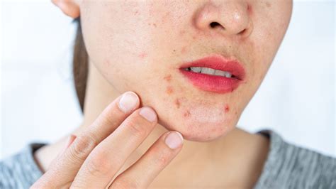 How to Get Rid of Chin Acne, According to Experts — Treat Pimples on the Chin