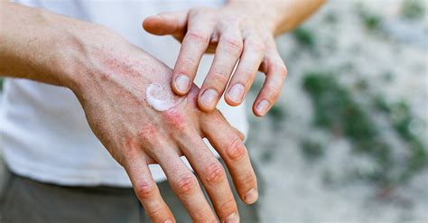 Dry Skin On Hands - Causes, Prevention & Cure | O’Keeffe’s | O'Keeffe's Australia