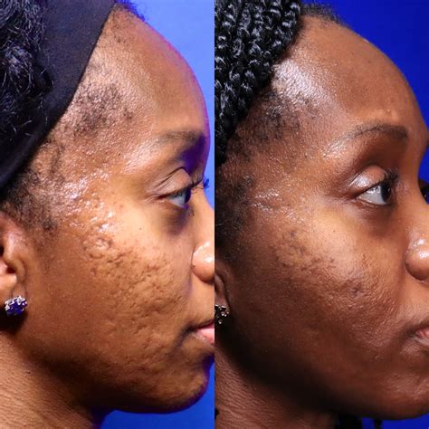 Acne Scar Treatment for Patients of African Descent