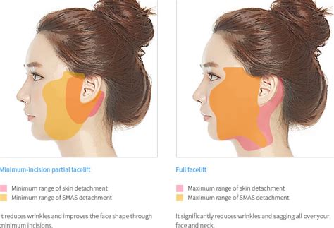 Rejuvenate your skin with just one SMAS facelift treatment