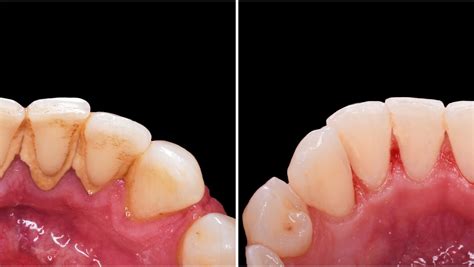 Deep Teeth Cleaning: Before and After - Dental Health Society