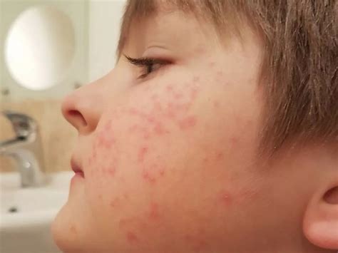 Bacterial Rash On Face