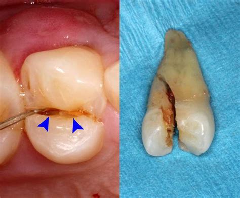 Dentist Cracked Tooth | Cracked Tooth Symptoms, Diagnosis & Treatment