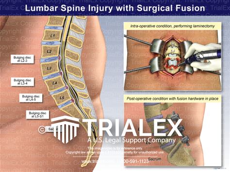 Lumbar Spine Injury with Surgical Fusion - TrialQuest Inc.