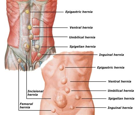 Inguinal Hernia Repair by Dr. David W. Ford