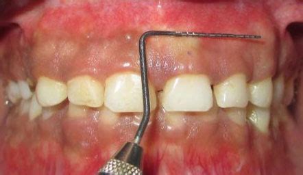 Mucogingival junction - Definition of Mucogingival junction