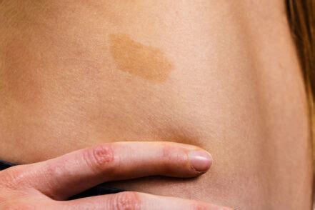 Cafe Au Lait Birthmarks: What They Are & Treatment Options