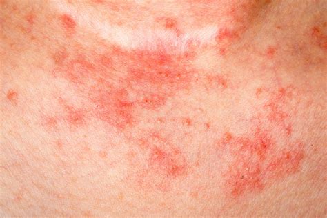 Eczema Facts: Things You Need To Know | The Healthy