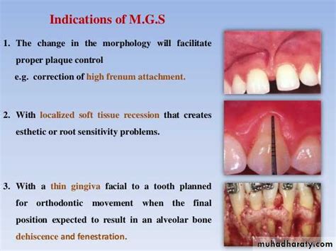 Mucogingival surgery pptx - د.عمر وليد - Muhadharaty