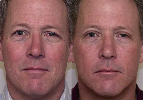 Eyelid Surgery (Blepharoplasty) Before and After Photo Gallery | Atlanta, Georgia | Buckhead ...