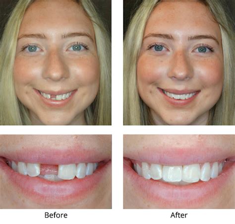 Tooth Crown Replacement in Bedford TX - Fixed Dental Bridge