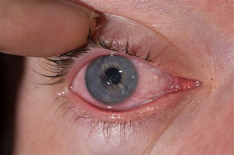 Corneal Abrasion Garden Grove | Orange County Ophthalmology