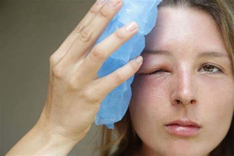 Swollen Eyelids: Causes & Treatment | MyVision.org (2023)