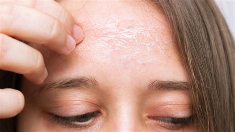 Why The Skin On Your Forehead May Be Flaking