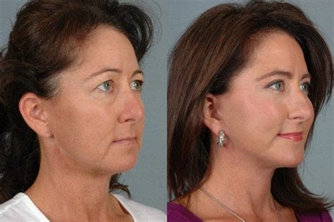 B-Spoke Clinic: Difference Between Facelift, Mid-Facelift, And Mini-Facelift