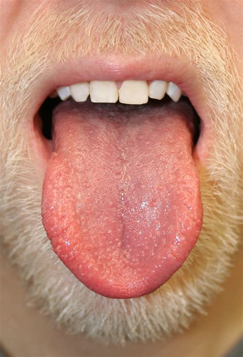 Bumps on the Tongue: What It Could Mean | Reader's Digest