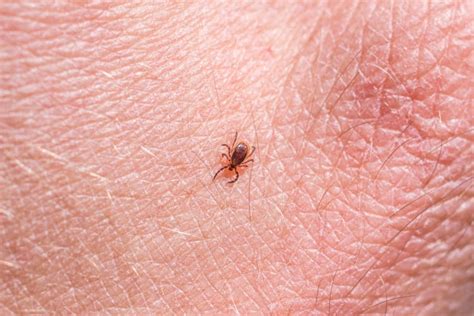 Tick-Borne Babesiosis Disease Cases Rising in Northeast, CDC Says