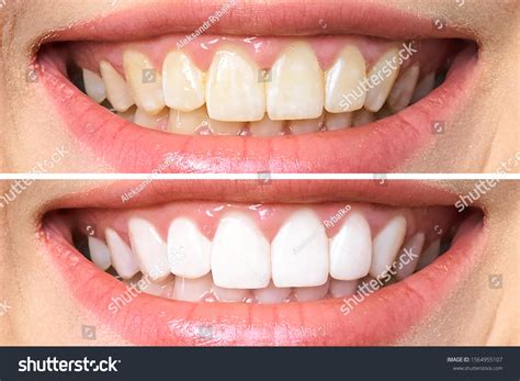 Woman Teeth Before After Whitening Over Stock Photo 1564955107 | Shutterstock