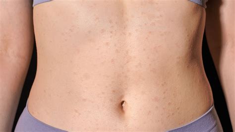 COVID-19 Rash: Types, Symptoms, and Treatment - GoodRx