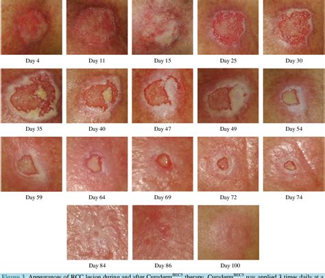 Basal Cell Skin Cancer Treatment