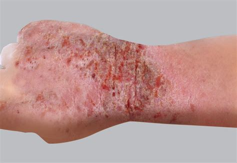 Eczema in adults | Eczema Foundation