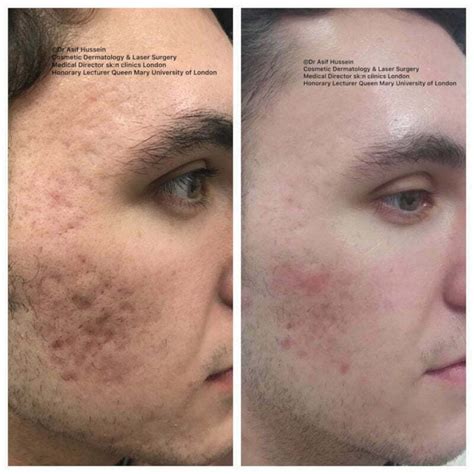 Acne Scar Laser Treatment & Removal London | Dr H Consult