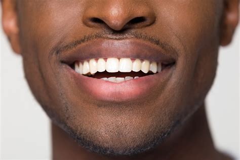 How Treating Gum Disease Can Improve Your Smile - White Smile Center Mobile Alabama