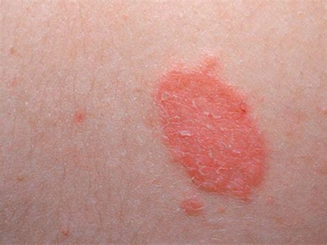 Dry Scaly Rash