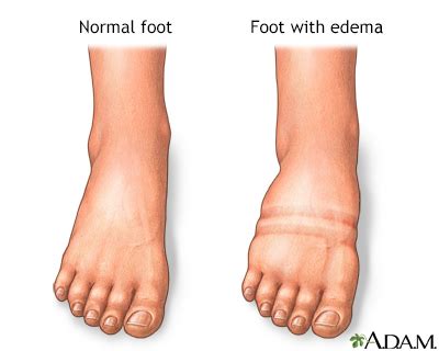 Foot, leg, and ankle swelling Information | Mount Sinai - New York