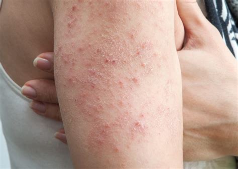 Why Is My Skin So Dry, Itchy & Rough? The Low Down on Eczema - Dr. Pimple Popper