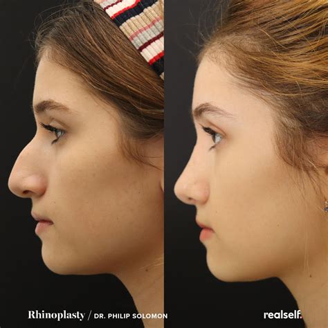 Rhinoplasty glasgow nose job nose surgery scotland – Artofit