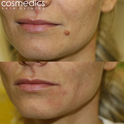 Before & After Photos | London Mole Removal