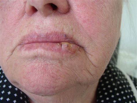 Lip Cancer: Causes Symptoms And Treatment – EadvVienna2020.org