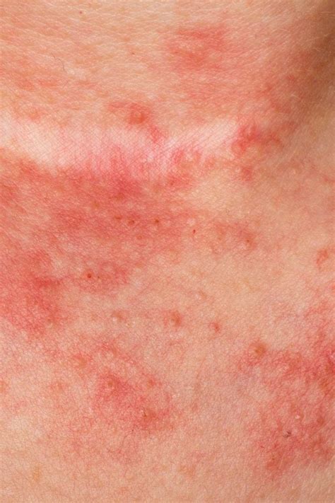 6 Tipos De Eczema Sintomas E Causas Respostas Sempre Atualizadas Themelower – Themeloader